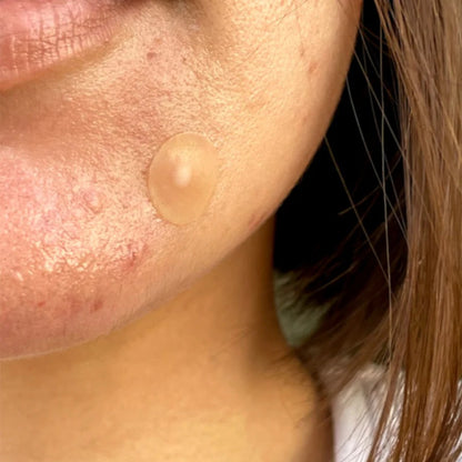 Acne Healing Dots Jumbo