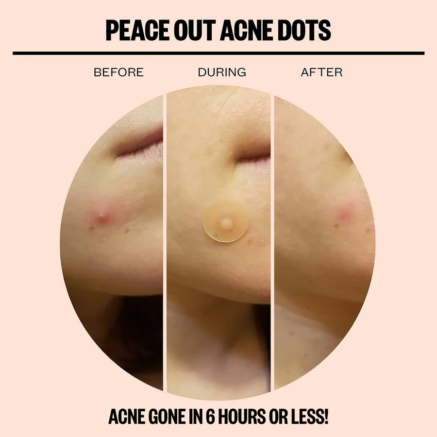 Acne Healing Dots Jumbo